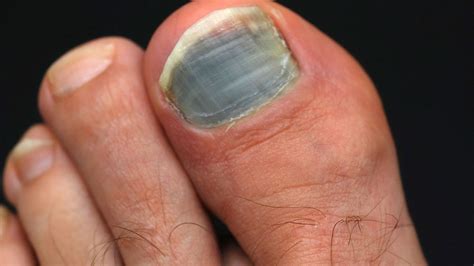 C Est Quoi Un Pied Noir Ongle de pied noir, à quoi est-il dû et comment le soigner ? • Pied Zen